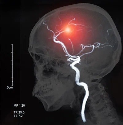 X-ray image of human skill with an overlay of a blood vessel