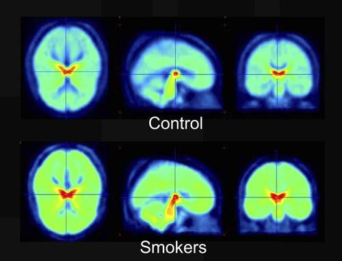 Nicotine receptor brain imaging