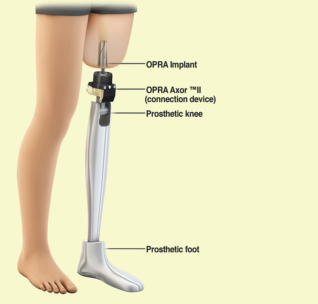 Prosthetic Science Creates Replacement Limbs In Texas