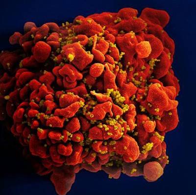 Micrograph of HIV-infected T cell, in which many instances of the virus are visible attaching to the surface of the cell