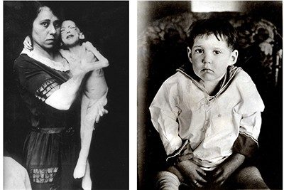 Two black and white photographs. On the left, a woman holds an emaciated toddler. On the right, the same toddler is at a healthier weight.