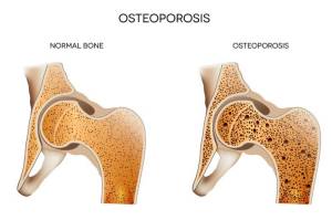 Illustration of bones weakened by osteoporosis