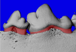 Bone resorption of teeth