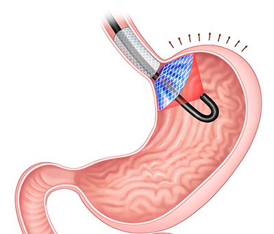 Scientific illustration of implant at top of stomach with laser indicated