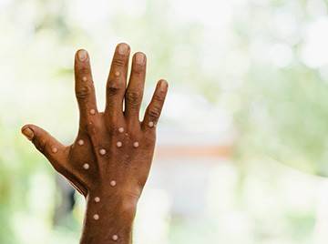 A raised hand with monkeypox