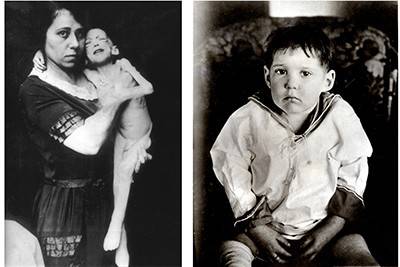 A photo showing a very thin boy held in a woman’s arms, next to another photo showing him at a healthy weight