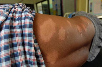 Several light-colored skin lesions on a patient’s back.