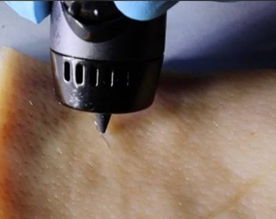 The tip of a 3D-printing pen, depositing a clear hydrogel into a cut made in a piece of pig skin.
