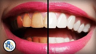 What's The Best Way To Whiten Teeth?  image